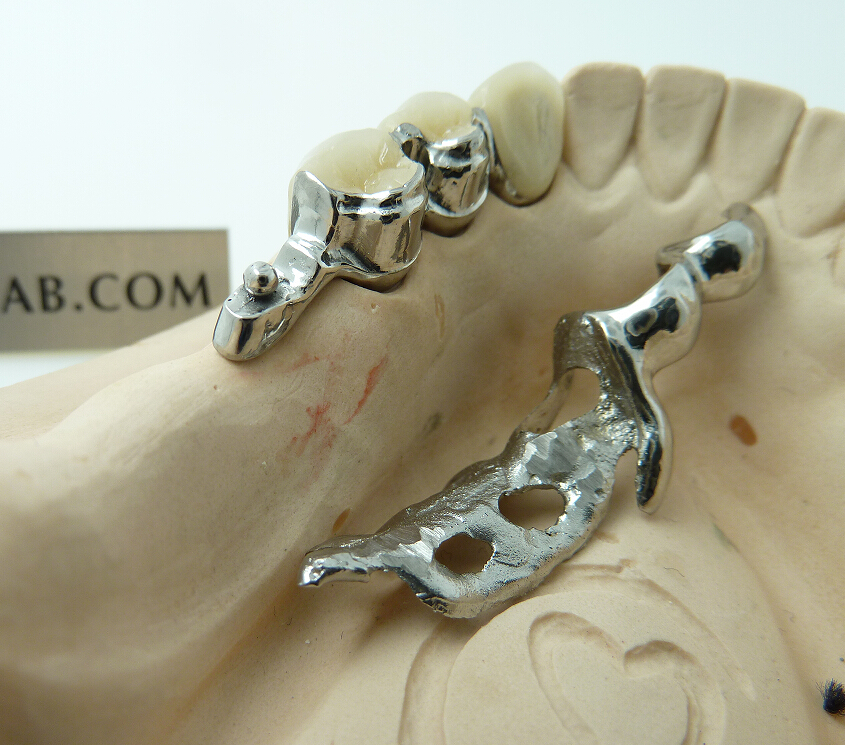 Flexible Denture